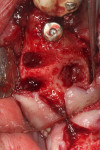 Fig 6. Implant placed in site No. 4; tooth No. 3 was sectioned and atraumatically extracted.