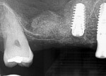 Fig 8. Implant placed in site No. 3 with site No. 2 grafted.