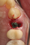 Fig 11. Implant placed in fresh extraction socket toward the palatal side of the socket.