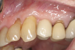 Fig 13. Screw-retained restoration 1 year after placement.