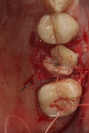 Fig 15. L-PRF plug sutured over amnion-chorion barrier and graft.