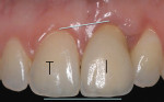 Fig 1. Implant restoration with higher gingival margin at day 0 (T = tooth, I = implant).