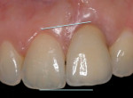 Fig 3. Vertical eruption of tooth No. 8 and ankylosis of the implant at 7 years.