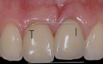 Fig 4. Incisal edge and margin discrepancies between the central incisors at 10 years (T = tooth, I = implant).