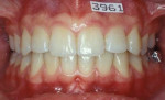 Fig 5. Clinical aspect after 5 years of orthodontic treatment, June 1994.