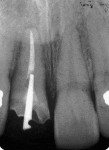 Fig 7. Endodontic treatment on tooth No. 8.
