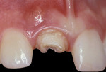 Fig 8. A fistula appeared a few weeks after endodontic treatment and temporary crown placement.