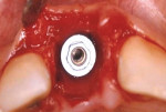 Fig 11. Implant with external hex in center of the alveolar socket.