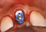 Fig 13. Sutures on the overcontoured ridge and around the customized healing abutment.