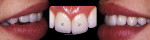 Fig 19. Implant/tooth restoration 2 years later, September 1998, with slight infraocclusion on the implant restoration (IR = implant restoration, LV = laminate veneer).