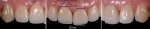 Fig 22. Right, frontal, and left views of the tooth and implant restoration, January 2014.