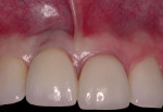 Fig 26. Initial surgical session after scaling/root planing/oral health maintenance.