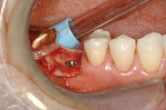 Figure 9: The implant is placed, partially subcrestal.