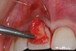Fig 30. Palatal CTG inserted into the tunnel above the implant restoration.