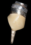 Fig 32. Old implant abutment placed in 1995 was removed.