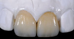 Fig 38. Frontal aspect implant restoration on No. 8 and laminated veneer on No. 9.