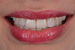 Fig 43. Patient’s new smile, with no disharmony on the incisal edges.