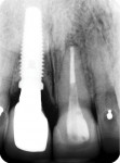 Fig 46. X-ray of the new implant restoration taken in December 2014, showing no change in proximal bone after 18 years.