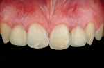 Fig 49. Existing bonded cantilever bridge with metallic wing replacing teeth Nos. 7 through 10, placed on a 15-year-old patient 20 years ago (case courtesy of Inaki Gamborena, DMD, MSD).