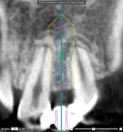 Fig 51. CBCT of Nos. 9, 10, and 11, showing apical root proximity.