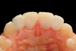 Fig 55. Occlusal view of the two ceramic non-splinted bonded cantilever bridges replacing the missing lateral incisors, from Nos. 7 through 11.