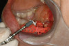 Figure  3  Severe dental erosion and attrition in a GERD patient.