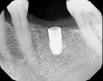 Figure 15  Radiographic verification of the implant placed as planned.