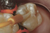 Figure  5  Loss of tooth surface and yellowing of teeth in a young patient with untreated GERD.