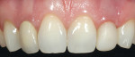Figure 1  Presenting dentition with PFM crowns on teeth Nos. 7 and 10.