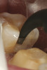 Figure  8  Loss of posterior teeth and altered occlusal load and resultant V-shaped tooth surface loss.