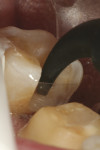 Figure 4  The gingival portion of the proximal box is shown, by virtue of a clear matrix band, early in the filling process. Note the perfect adaptation of the SonicFill composite material to this critical area of the cavity.