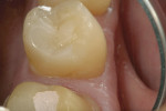 Figure 5  A 2-week postoperative view of the DO SonicFill composite restoration on tooth No. 29.