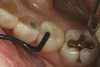 Figure  10  The Class V lesion restored with self-adhesive resin-based composite.