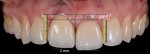 Fig 25. Analysis of the gingival and incisal edge discrepancies.