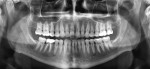 Figure 1  A contemporary panoramic radiograph of an adult patient showing overlap between the bicuspids. Excellent overall image quality shows maxillary sinuses, temporomandibular joint condyles, the airway, as well as the bone of the maxilla and man