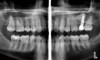 Figure  13   This patient was unhappy with the unesthetic appearance due to tooth surface loss.