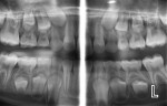 Figure 4  A panoramic bitewing projection of a 9-year-old patient, which was taken to examine the interproximal surfaces of the primary molars as well as the position and presence of the permanent dentition. Note that the conventional digital panoram