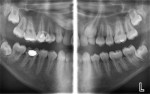 Figure 5  A panoramic bitewing projection of a 15-year-old female patient showing the impacted maxillary canines, as well as the developing third molars. The maxillary right primary second molar is retained (only very slightly) as well as the primary