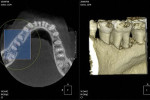 Figure 7  Three-dimensional reconstructed image of the bone loss from a small field-of-view (4 x 4 cm) machine from the author’s radiology practice, using the “cube tool” in a third-party software called OnDemand3D (CyberMed, Irvine, CA). This