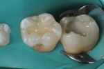 Figure 5  A flowable composite was placed in a thin layer and manipulated with an explorer and light-cured.