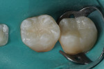 Figure  7  Tetric EvoCeram Translucent shade was placed to build the restoration to full contour.