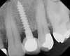 Figure 6  Alveolar ridge form permitted optimal implant placement (5 months posttreatment).