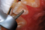 The enamel surface in the lingual fossa was roughened with a roundtipped diamond bur.