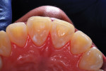 Occlusal photograph of both lateral incisors taken 32 months postoperatively.