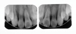 Radiographs of both lateral incisors taken 32 months postoperatively