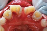 Pretreatment maxillary occlusal view of an 8-year-old girl with the lateral incisors and right central incisor exhibiting dens invaginatus defects.