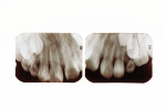Pretreatment radiographs of the patient’s maxillary anterior region showing dens invaginatus defects.