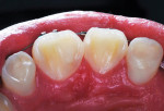 Close-up occlusal photograph of the three restored incisors taken 55 months postoperatively.