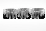 Radiographs of the restored incisors taken 55 months postoperatively.