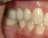 Figure 9  Maxillary right central incisor fractured below gingival margin.